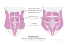 Diastasis-Recti-V3.webp