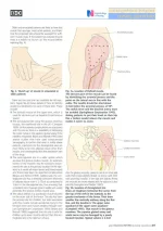 Injection Techniques3.webp