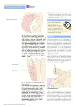Injection Techniques4.webp