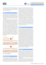 Injection Techniques5.webp