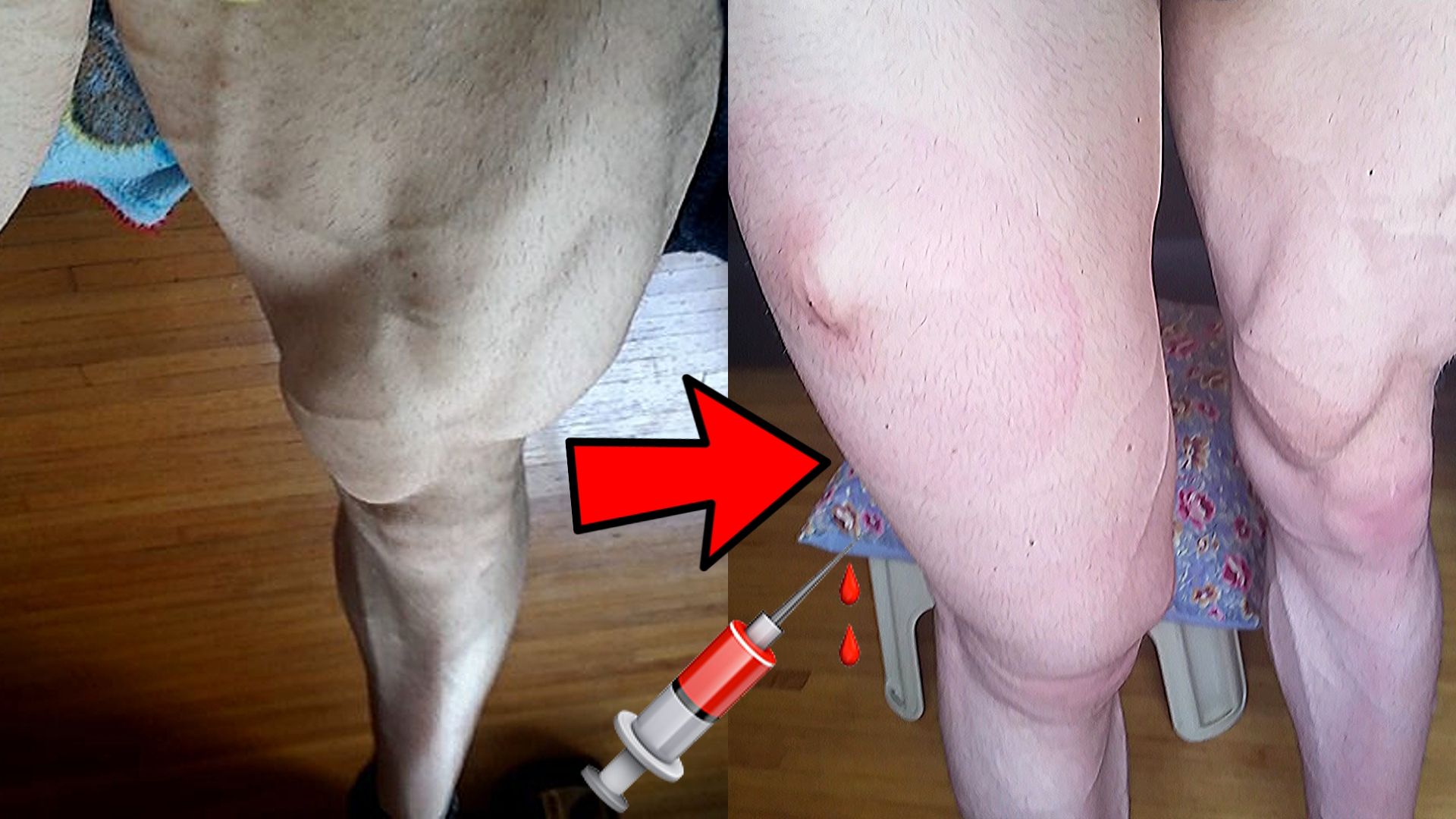 Quad Injection | Why You Should NEVER Inject Your Quads