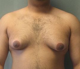 Possible Steroid Side Effects