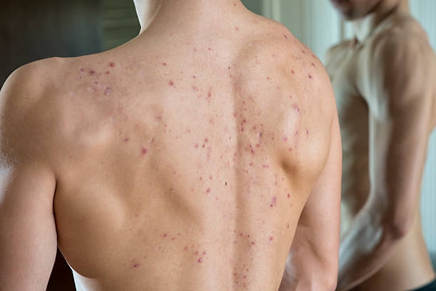 Steroid Acne in Men: Causes, Treatment, and Prevention