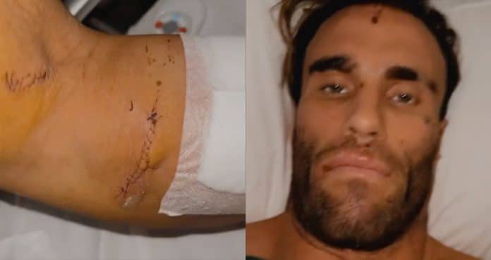Calum Von Moger Displays Accident Wounds From Hospital Bed In Update